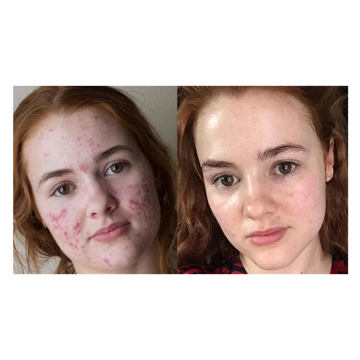 Medical-Grade Hydrocolloid Acne Roll