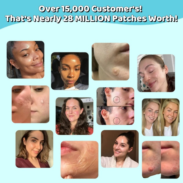 Medical-Grade Hydrocolloid Acne Roll