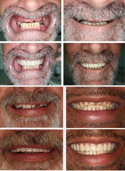 🔥 Last Day 49% OFF - Latest👨‍⚕Adjustable Snap-On Dentures😁