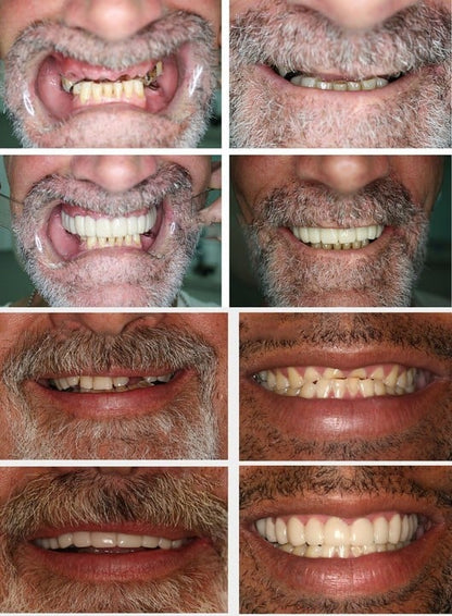 🔥 Last Day 49% OFF - Latest👨‍⚕Adjustable Snap-On Dentures😁