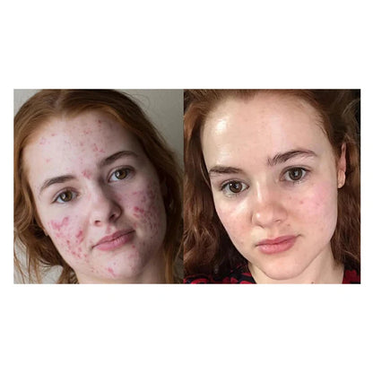 Medical-Grade Hydrocolloid Acne Roll